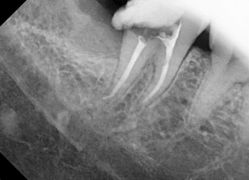 Yaksu Station Dental Clinic: Impacted Wisdom Tooth Extraction (Root Canal Treatment, Crown Treatment) 사진 3