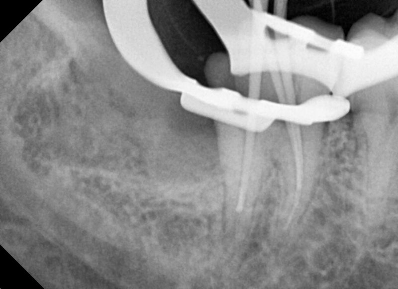 Yaksu Station Dental Clinic: Impacted Wisdom Tooth Extraction (Root Canal Treatment, Crown Treatment) 사진 2