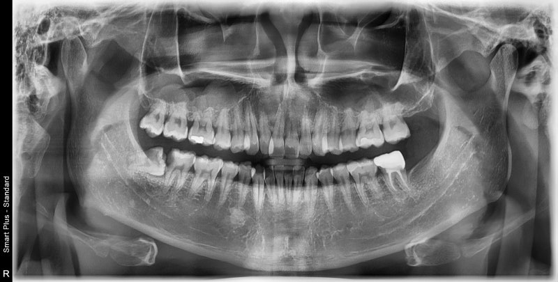 Yaksu Station Dental Clinic: Impacted Wisdom Tooth Extraction (Root Canal Treatment, Crown Treatment)