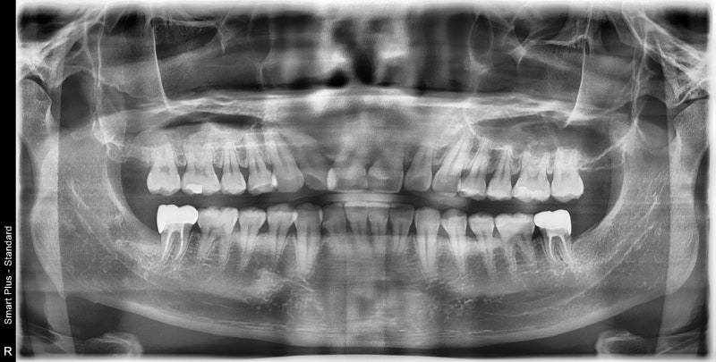 Yaksu Station Dental Clinic: Impacted Wisdom Tooth Extraction (Root Canal Treatment, Crown Treatment) 사진 4