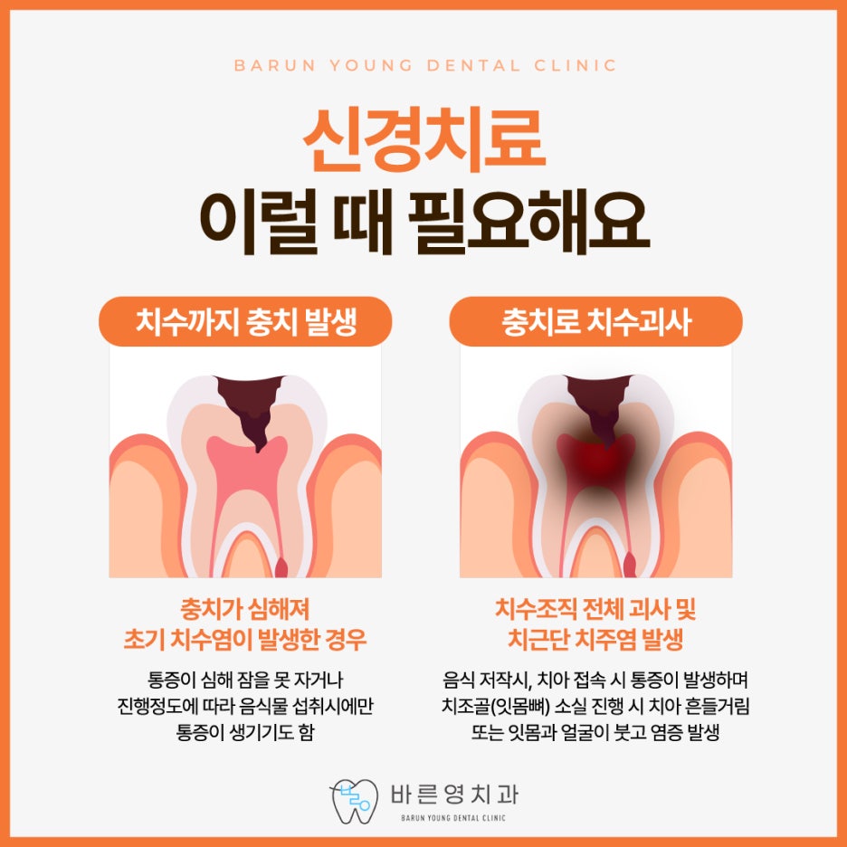 Oksu-dong Dental Clinic: Preserving Natural Teeth with Cavity and Root Canal Treatment 사진 7