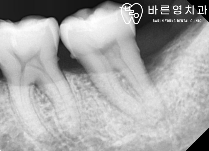 옥수역치과, 충치치료 조기에 해야 자연치아 보존률 UP! 사진 11