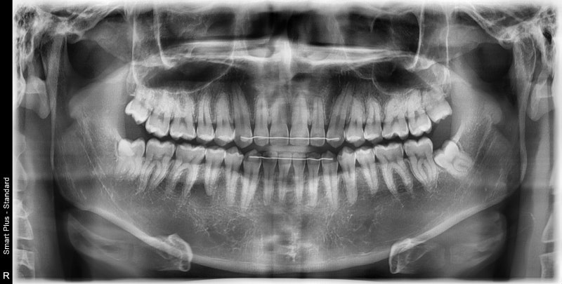 Klinik Gigi Stasiun Yaksu, Penyakit Terkait Sendi Temporomandibular (Perawatan Botox)