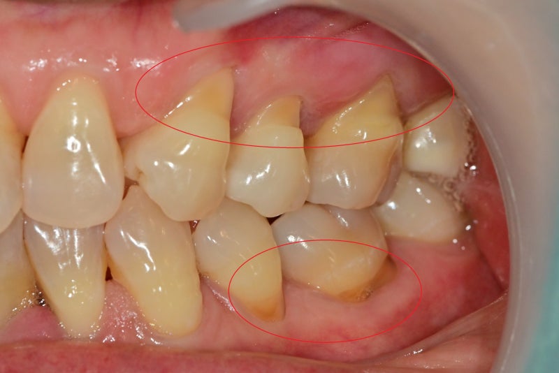 Klinik Gigi Stasiun Yaksu, Penyakit Terkait Sendi Temporomandibular (Perawatan Botox) 사진 6