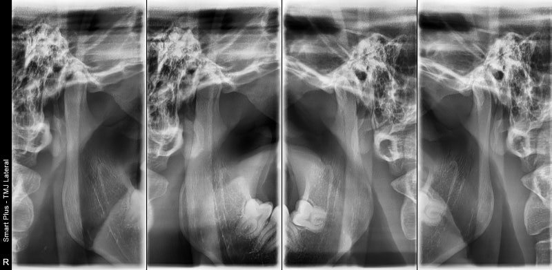 Klinik Gigi Stasiun Yaksu, Penyakit Terkait Sendi Temporomandibular (Perawatan Botox) 사진 3