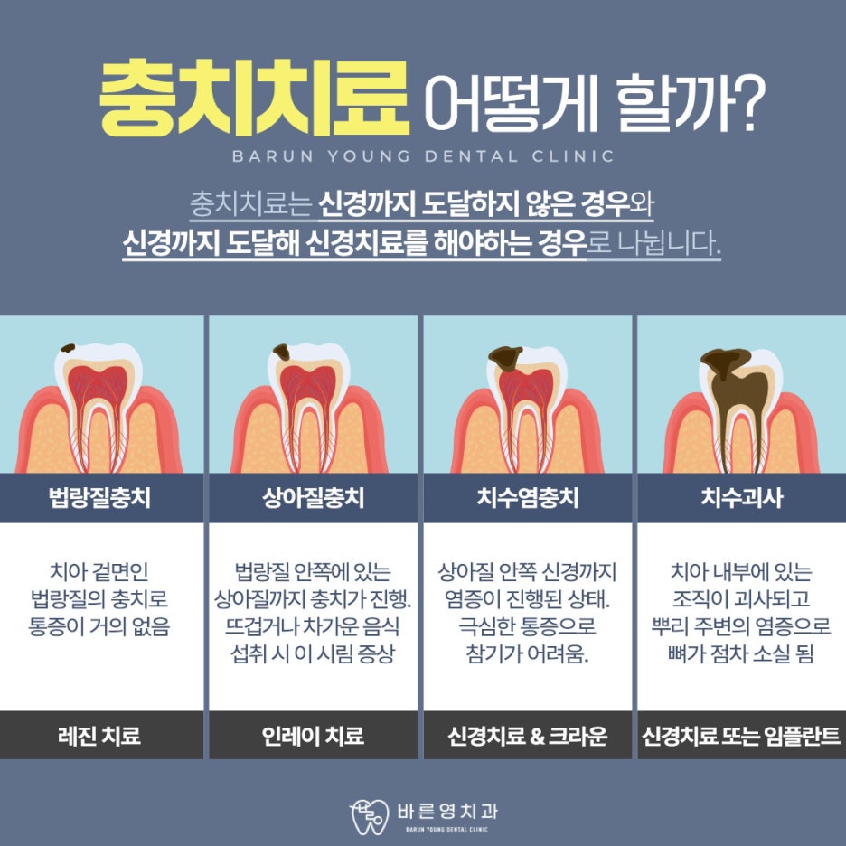 Jangan Lewatkan Waktu Perawatan Gigi Berlubang dan Perawatan Saraf di Klinik Gigi Cheonggu-dong 사진 7