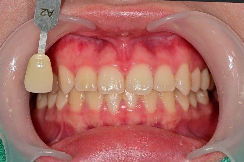 Yaksu Station Dental Clinic: Can a single visit for teeth whitening be effective? (feat. One-Day Whitening) 사진 7