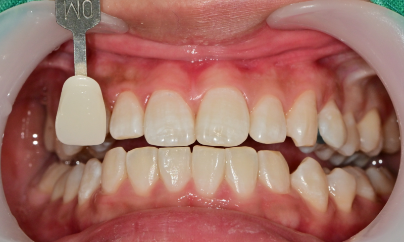 Yaksu Station Dental Clinic: Can a single visit for teeth whitening be effective? (feat. One-Day Whitening) 사진 6