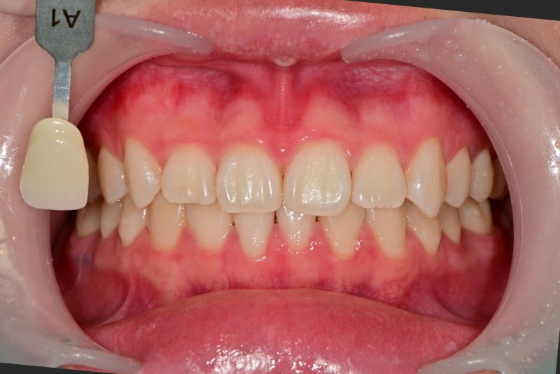Yaksu Station Dental Clinic: Can a single visit for teeth whitening be effective? (feat. One-Day Whitening) 사진 8