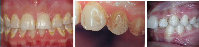 Yaksu Station Dental Clinic: Can a single visit for teeth whitening be effective? (feat. One-Day Whitening) 사진 2