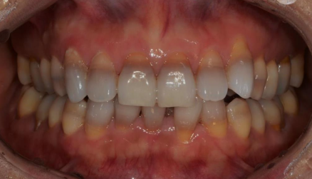Yaksu Station Dental Clinic: Can a single visit for teeth whitening be effective? (feat. One-Day Whitening)