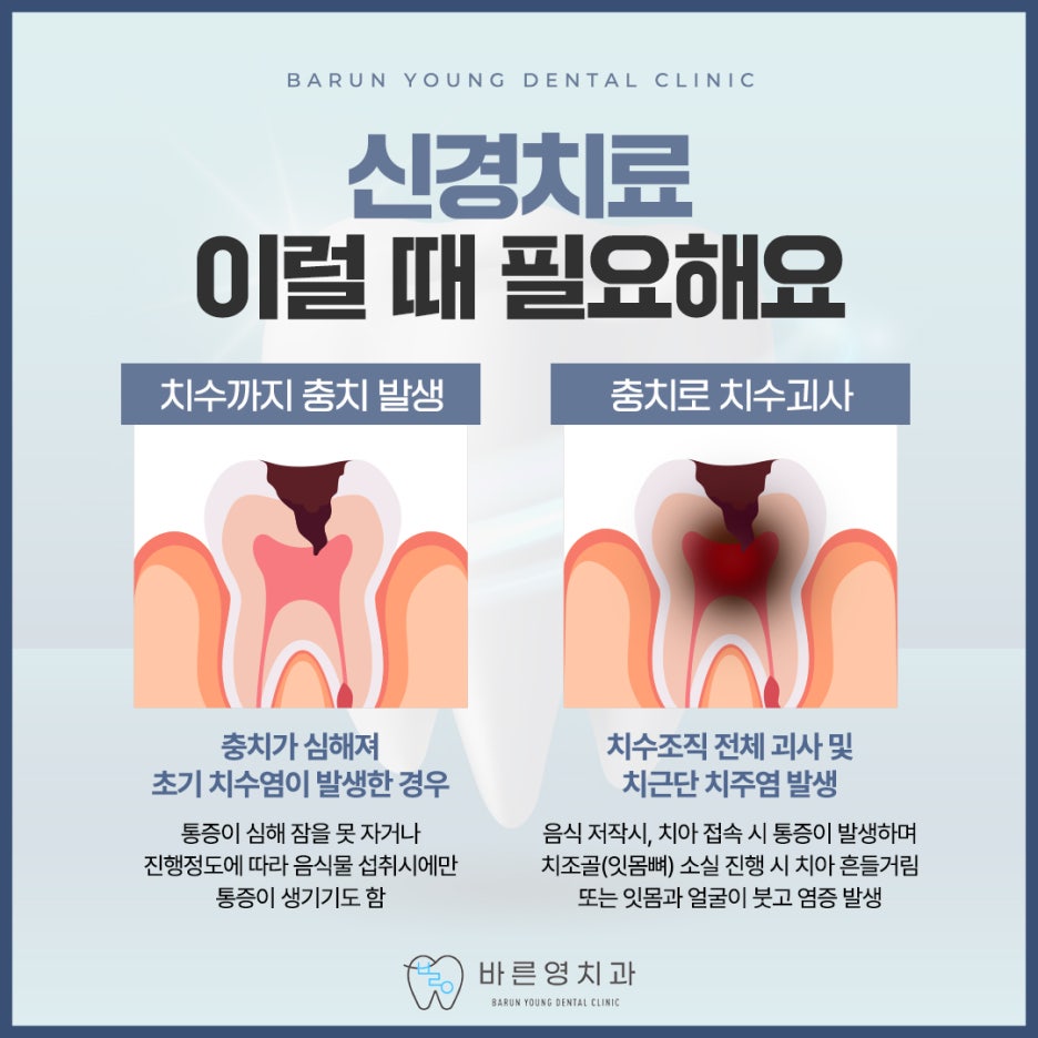 약수역치과 이 시림 방치말고 충치치료 해야 사진 8