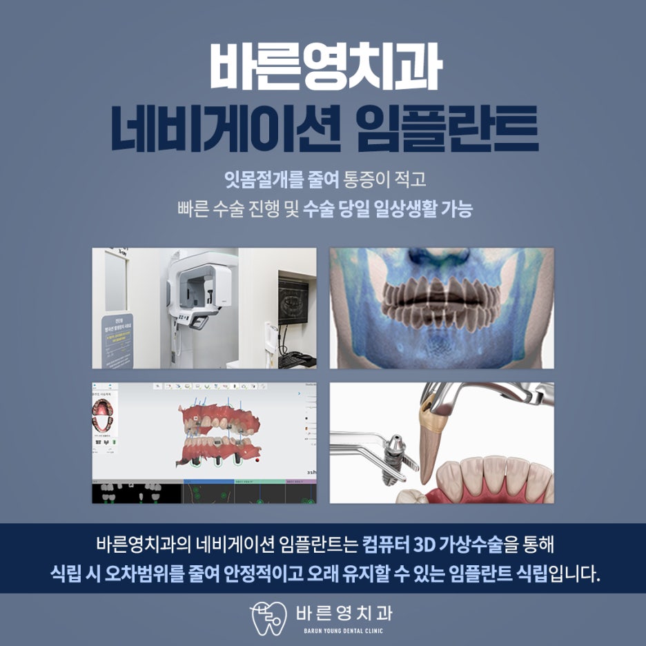 Kumho Station Dental Clinic: Navigation Implants – Knowing the Path Before Placement 사진 9