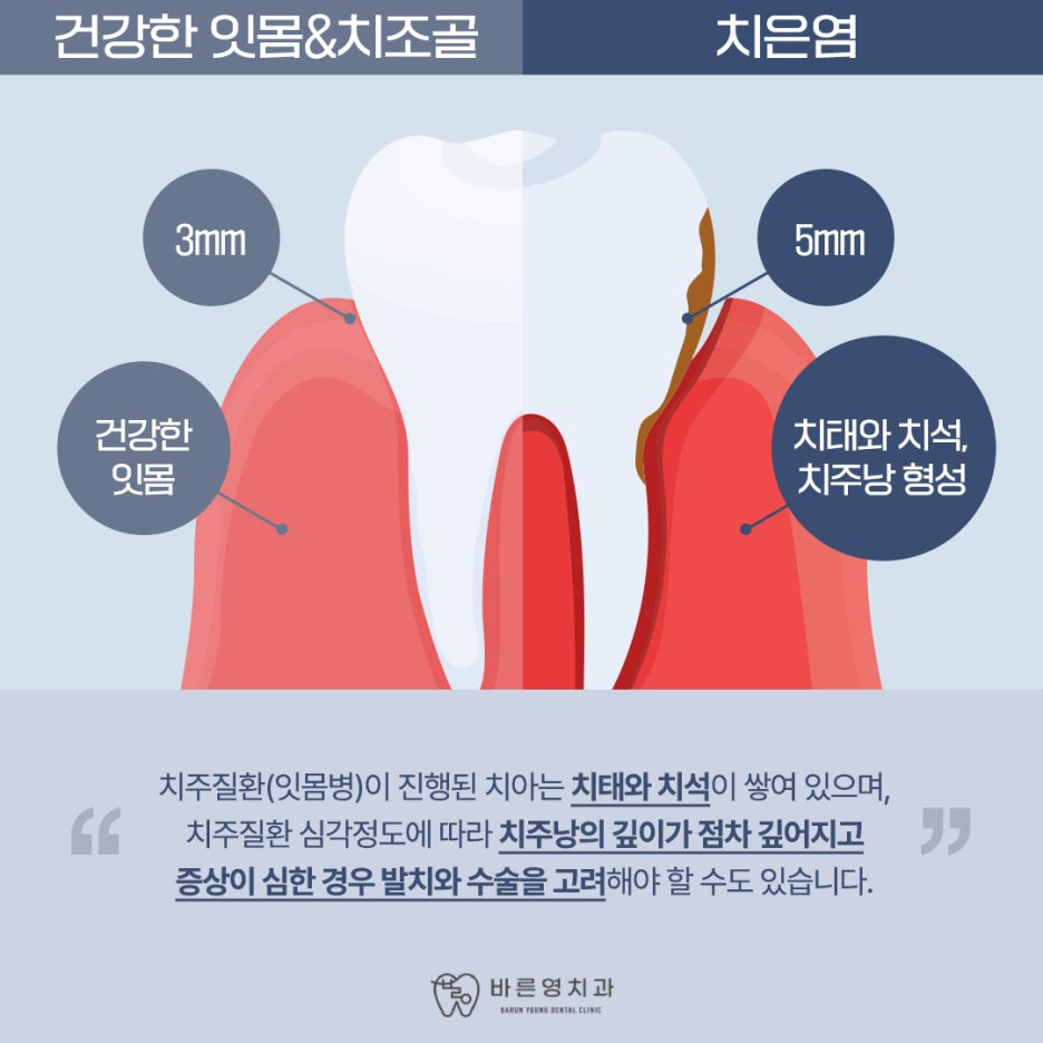 약수동치과 잇몸 피나고 치아 흔들거린다면