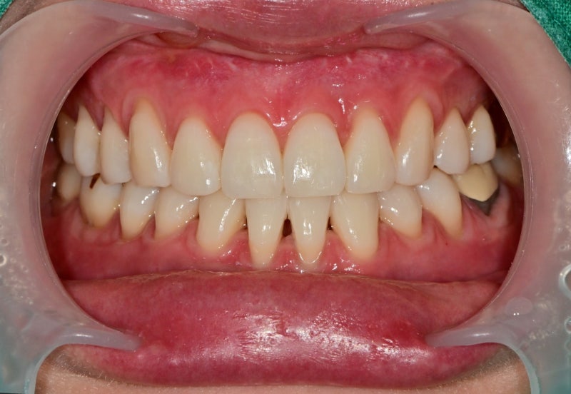 Yaksu Station Dental Clinic: The Effects and Frequency of Teeth Whitening 사진 4