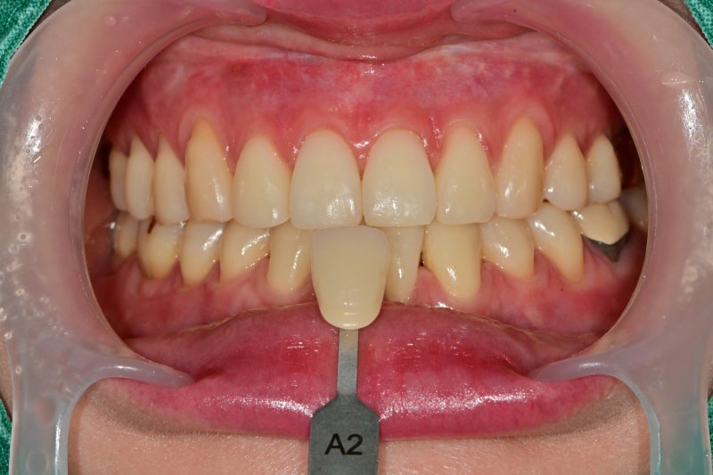 Yaksu Station Dental Clinic: The Effects and Frequency of Teeth Whitening 사진 2