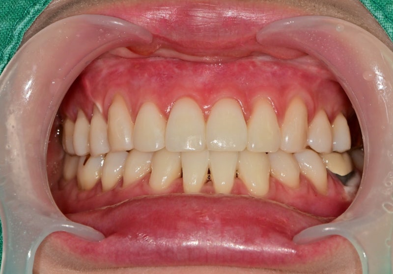 Yaksu Station Dental Clinic: The Effects and Frequency of Teeth Whitening 사진 3