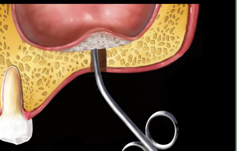 Yaksu Station Dental Clinic: Implant Procedures with Alveolar Bone Grafting and Pain Management (Sinus Lift) 사진 8