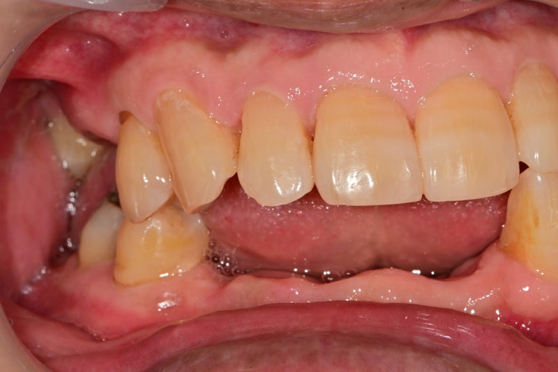 Yaksu Station Dental Clinic: Implant Procedures with Alveolar Bone Grafting and Pain Management (Sinus Lift)