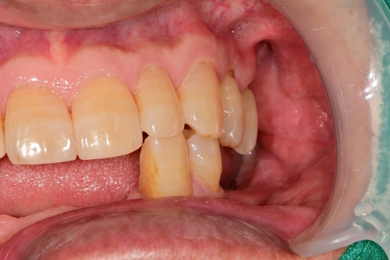 Yaksu Station Dental Clinic: Implant Procedures with Alveolar Bone Grafting and Pain Management (Sinus Lift) 사진 2