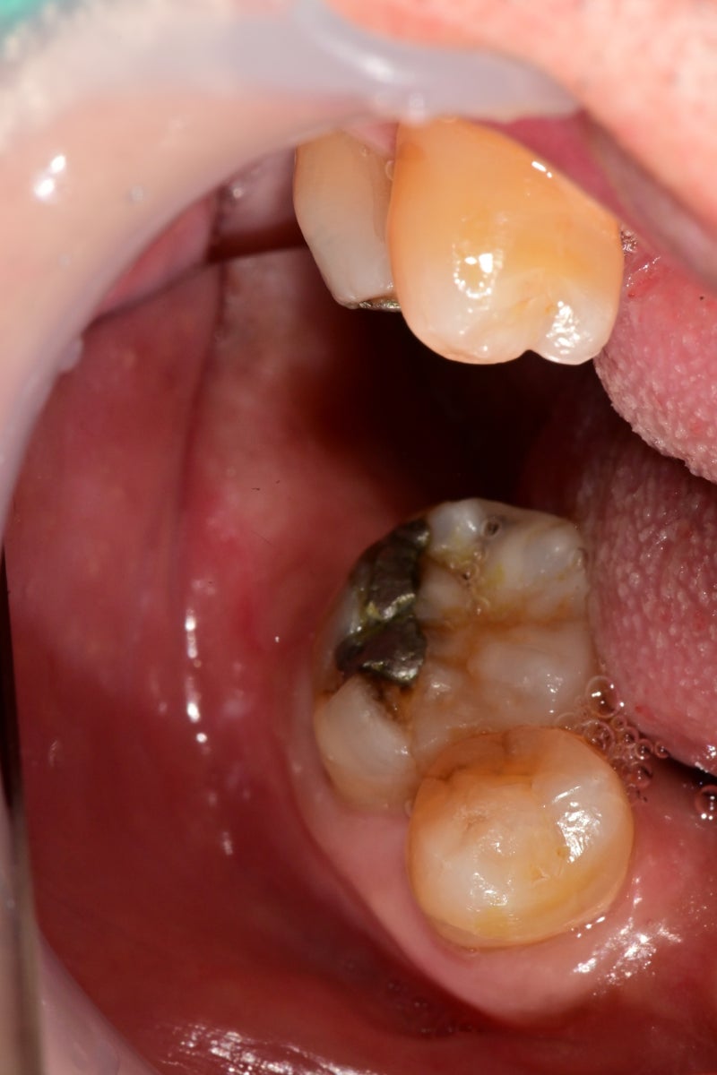 Yaksu Station Dental Clinic: Implant Procedures with Alveolar Bone Grafting and Pain Management (Sinus Lift) 사진 3