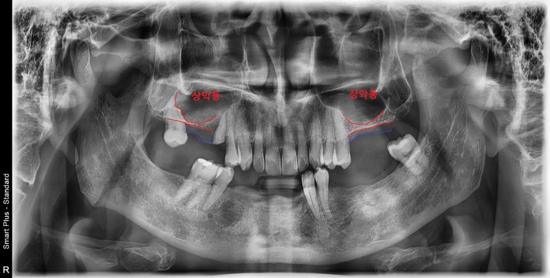 Yaksu Station Dental Clinic: Implant Procedures with Alveolar Bone Grafting and Pain Management (Sinus Lift) 사진 5
