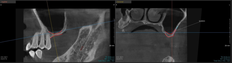 Yaksu Station Dental Clinic: Implant Procedures with Alveolar Bone Grafting and Pain Management (Sinus Lift) 사진 7