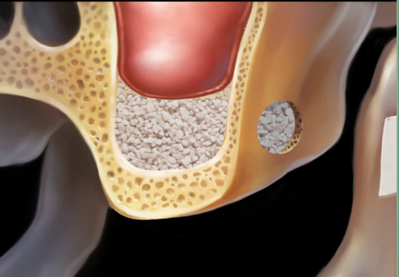 Yaksu Station Dental Clinic: Implant Procedures with Alveolar Bone Grafting and Pain Management (Sinus Lift) 사진 9