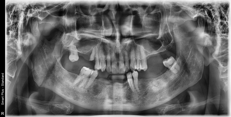 Yaksu Station Dental Clinic: Implant Procedures with Alveolar Bone Grafting and Pain Management (Sinus Lift)