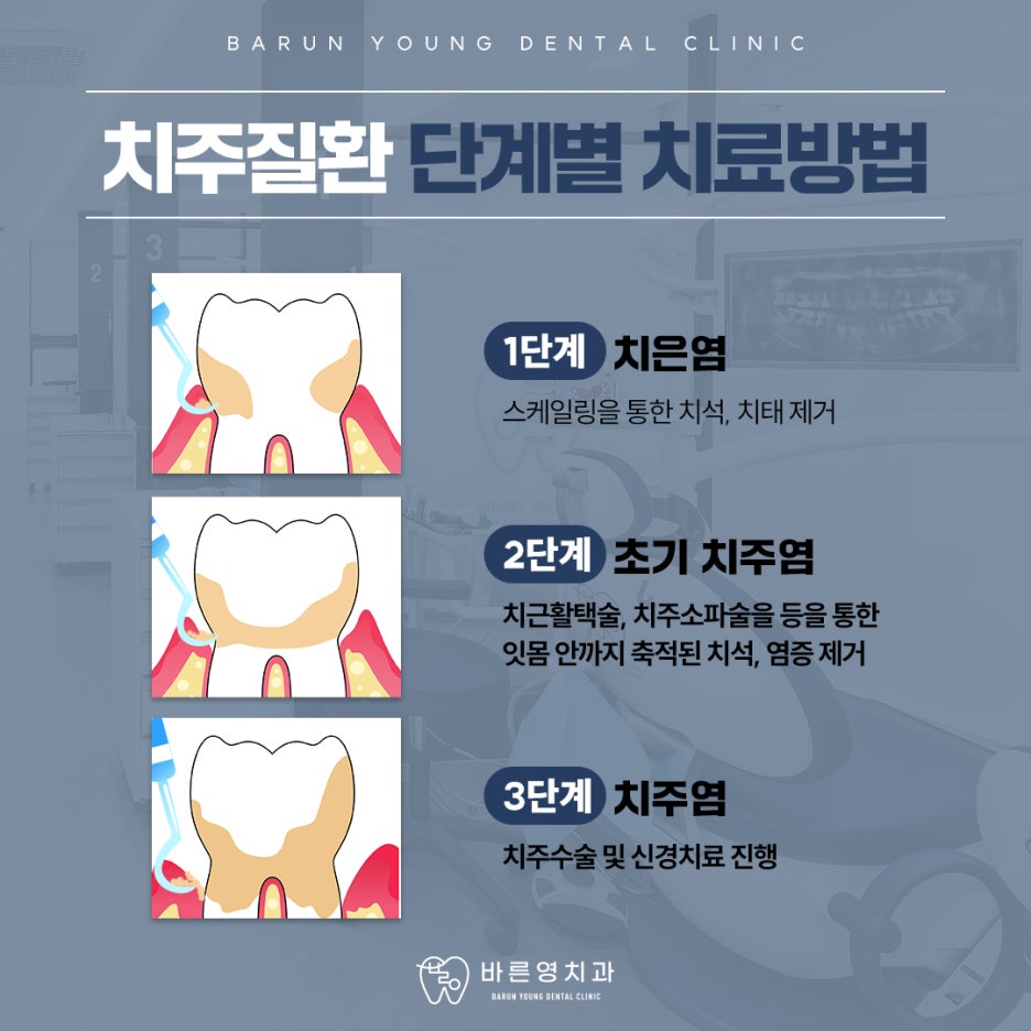 Oksu-dong Dental Clinic: Why Timely Treatment for Periodontal Disease (Pungchi) is Crucial 사진 13