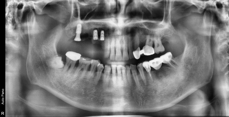 Yaksu Station Dental Clinic: Implant Surgery with Navigation (Guided Implants)