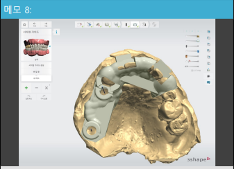Yaksu Station Dental Clinic: Implant Surgery with Navigation (Guided Implants) 사진 5