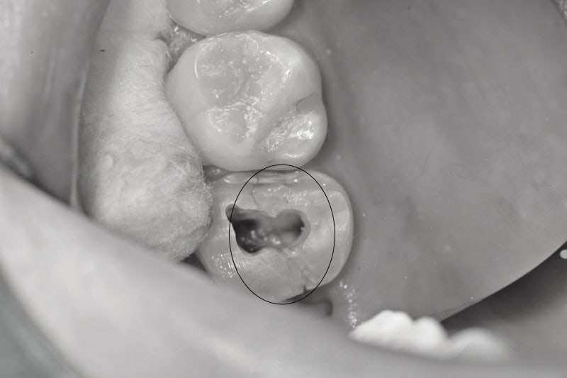 Yaksuyeok Dental Clinic: Treating Cracked Teeth (MTA)