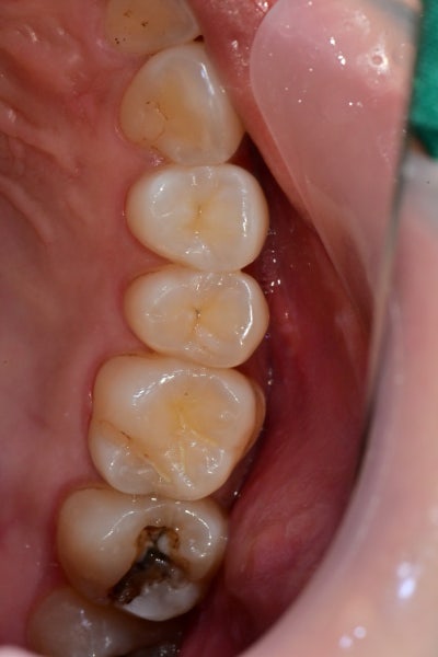 Yaksuyeok Dental Clinic: Treating Cracked Teeth (MTA)