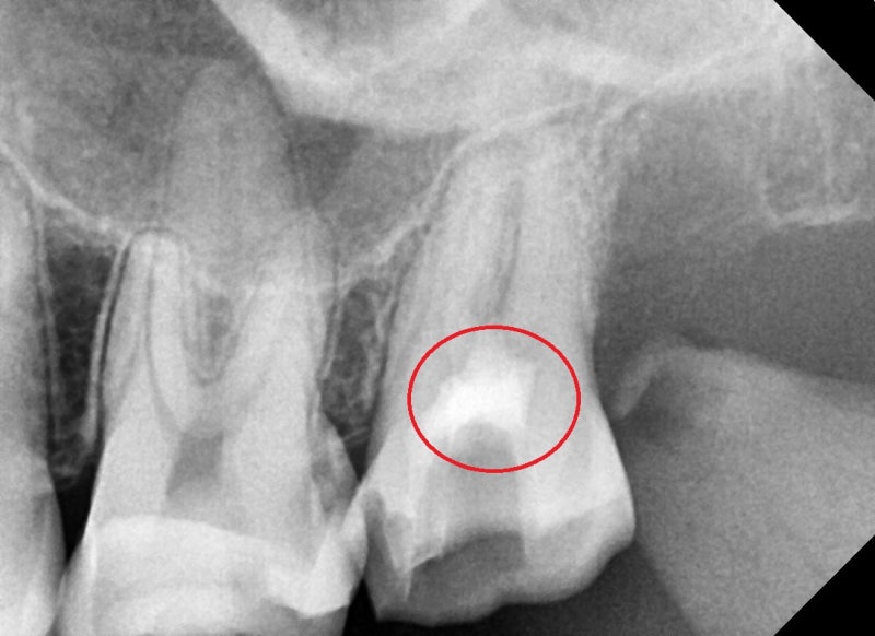 Yaksuyeok Dental Clinic: Treating Cracked Teeth (MTA) 사진 4