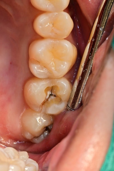 Yaksuyeok Dental Clinic: Treating Cracked Teeth (MTA) 사진 2