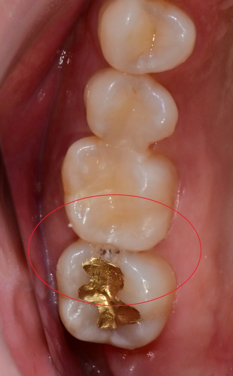 Yaksu Station Dental Clinic: Treating Deep Cavities (Using MTA) 사진 6