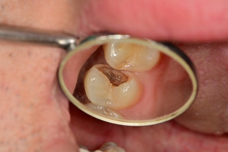 Yaksu Station Dental Clinic: Treating Deep Cavities (Using MTA)