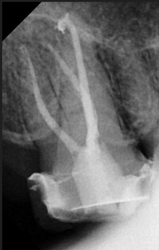 Yaksu Station Dental Clinic: Treating Deep Cavities (Using MTA) 사진 9