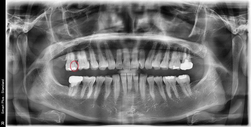 Yaksu Station Dental Clinic: Treating Deep Cavities (Using MTA)
