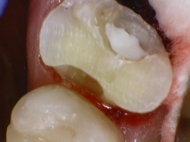 Yaksu Station Dental Clinic: Treating Deep Cavities (Using MTA) 사진 3