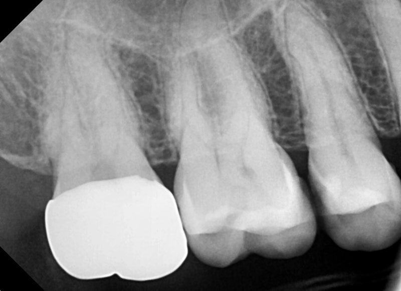 Yaksu Station Dental Clinic: Treating Deep Cavities (Using MTA) 사진 8