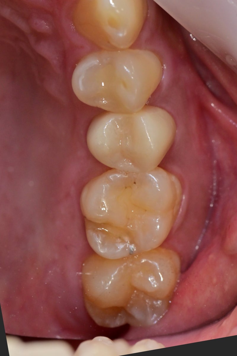 Yaksu Station Dental Clinic: Treating Deep Cavities (Using MTA) 사진 4