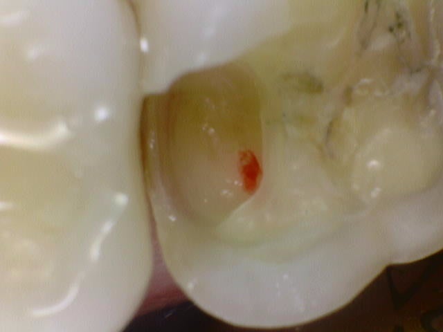 Yaksu Station Dental Clinic: Treating Deep Cavities (Using MTA) 사진 7