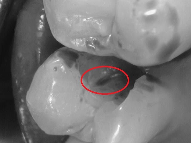 Yaksu Station Dental Clinic: Treating Deep Cavities (Using MTA) 사진 2