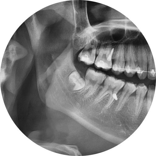 Yaksu Station Dental Clinic: Wisdom Tooth Extraction Should Be Decided Based on Condition 사진 6
