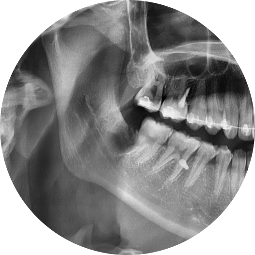 Yaksu Station Dental Clinic: Wisdom Tooth Extraction Should Be Decided Based on Condition 사진 7