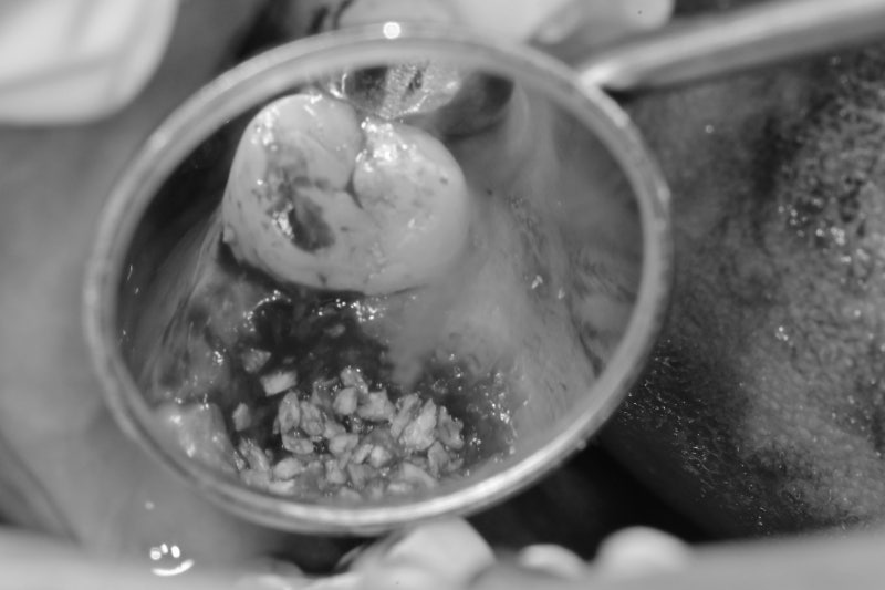 Yaksu Station Dental Clinic: What is the optimal time for implant surgery after extraction? 사진 3