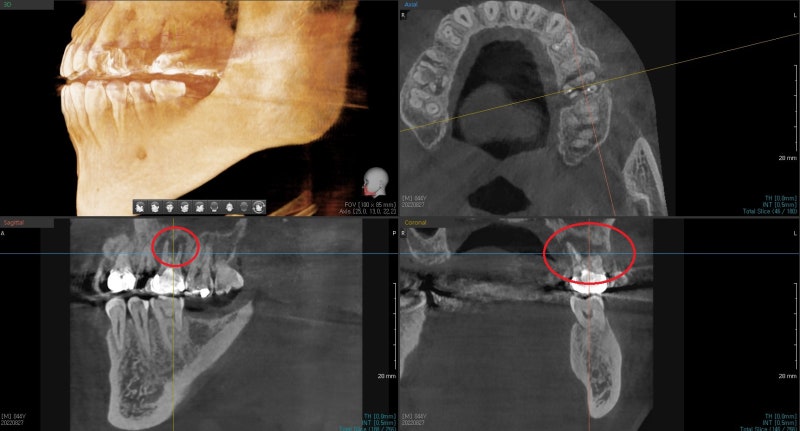 Yaksu Station Dental Clinic: What is the optimal time for implant surgery after extraction?