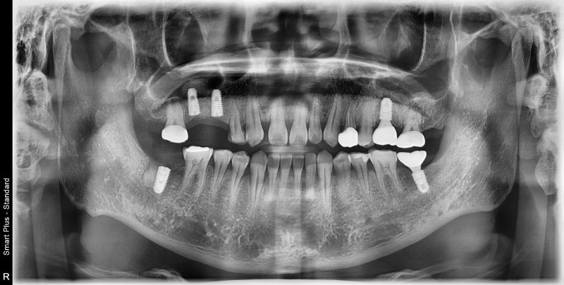 Yaksu Station Dental Clinic: What is the optimal time for implant surgery after extraction? 사진 6